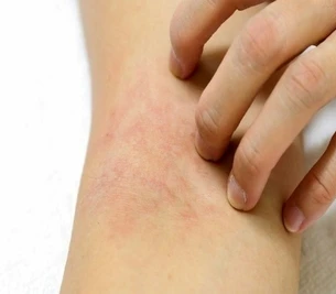 Leiden Sie an einem atopischen Ekzem?