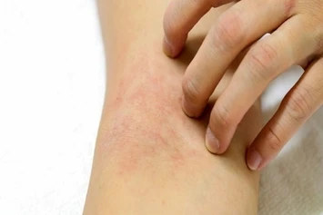 Are you suffering from atopic eczema?