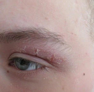 The Impact of Nutrition on Skin Diseases from a Nutrition Therapist’s Perspective