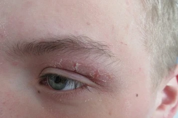 The Impact of Nutrition on Skin Diseases from a Nutrition Therapist’s Perspective